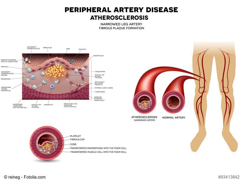 What is Peripheral Arterial Disease?
